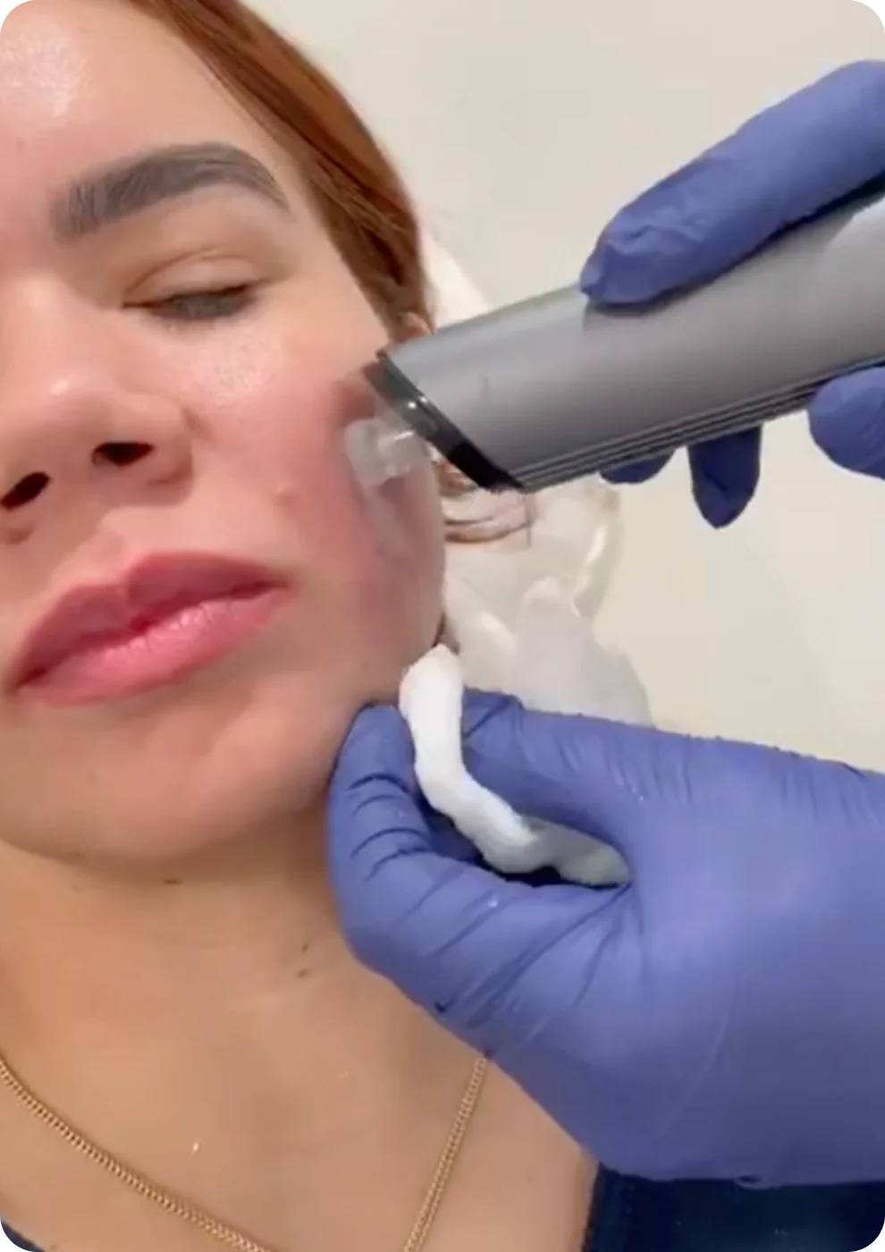 A patient receiving a treatment on her skin