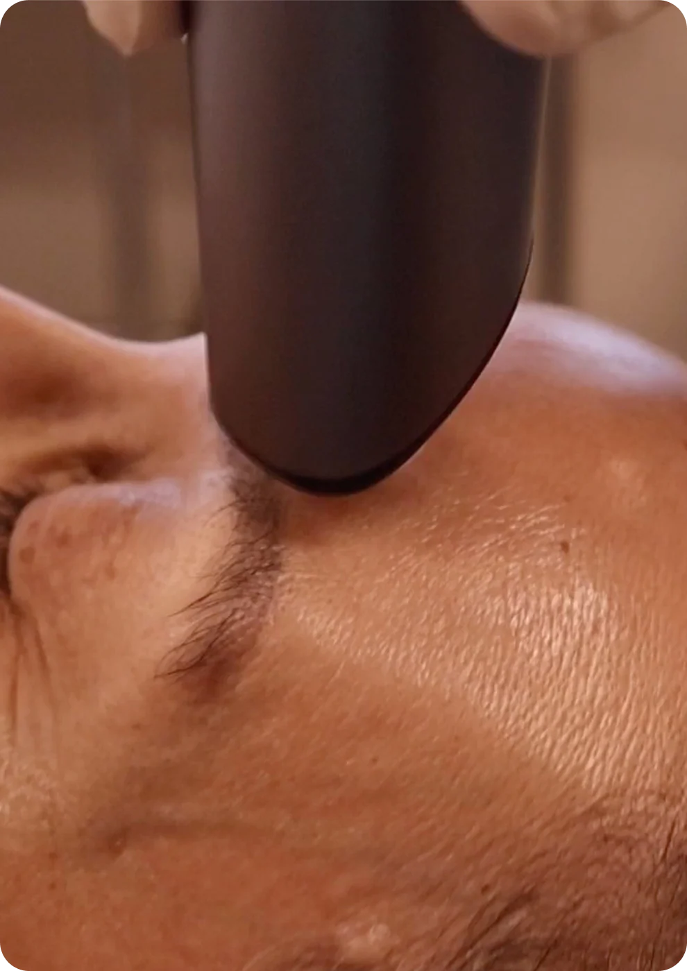 A juvasonic treatment of a man’s scalp