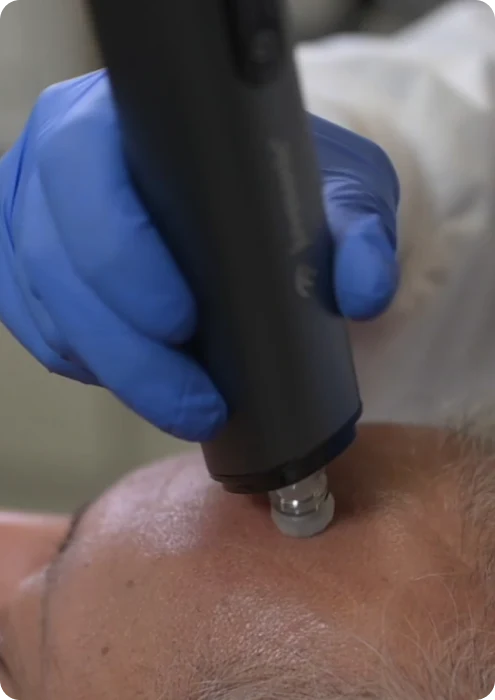 The juvasonic device being used mid treatment