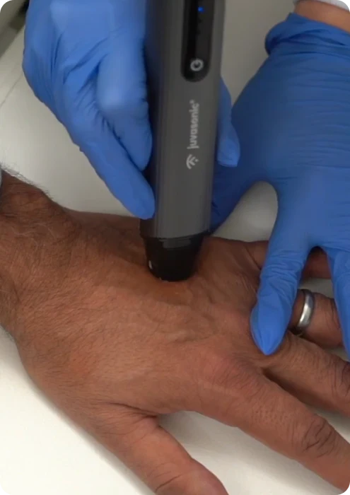 The juvasonic device used on a patients hand